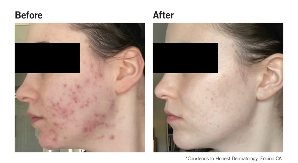 Acne Peel