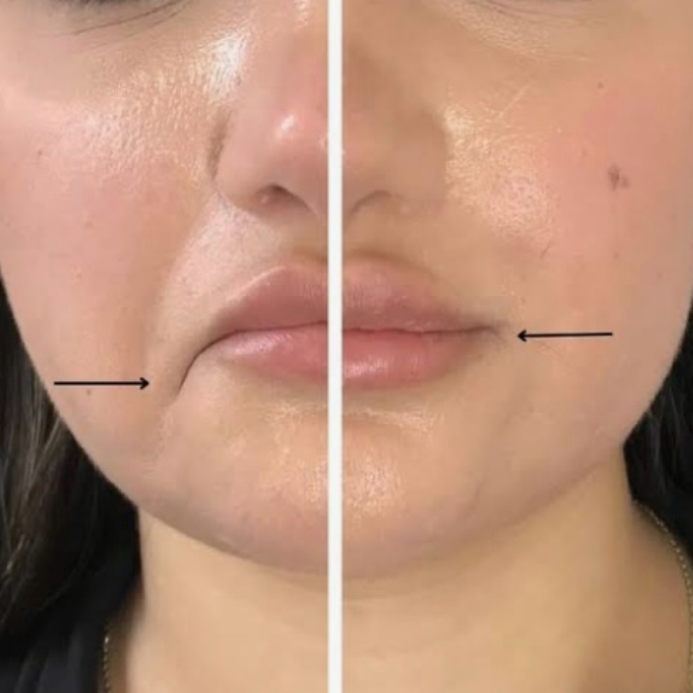 DAO Treatment at Glam X Sam MedBeauty in Andrews, TX
