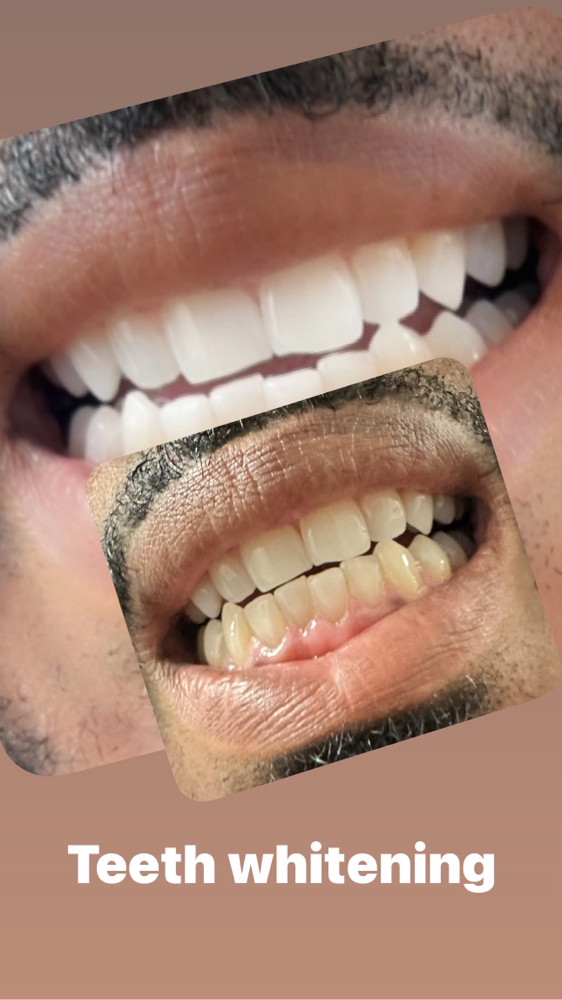 Teeth Whitening