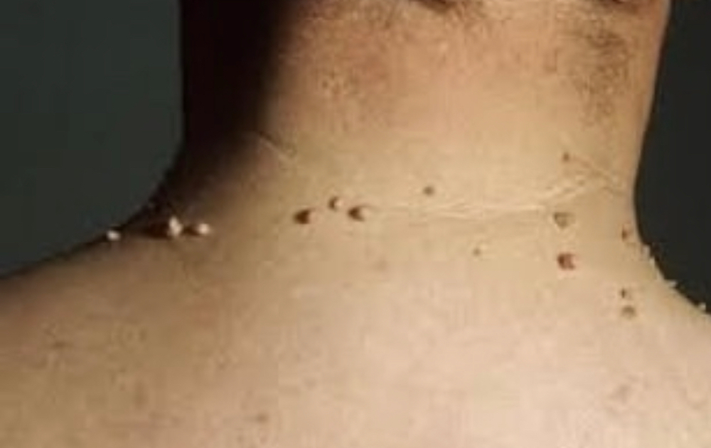 Skin tag removal