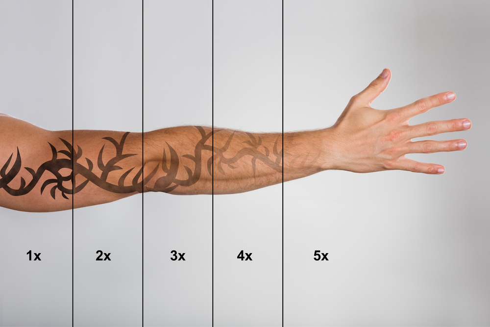Tattoo Removal