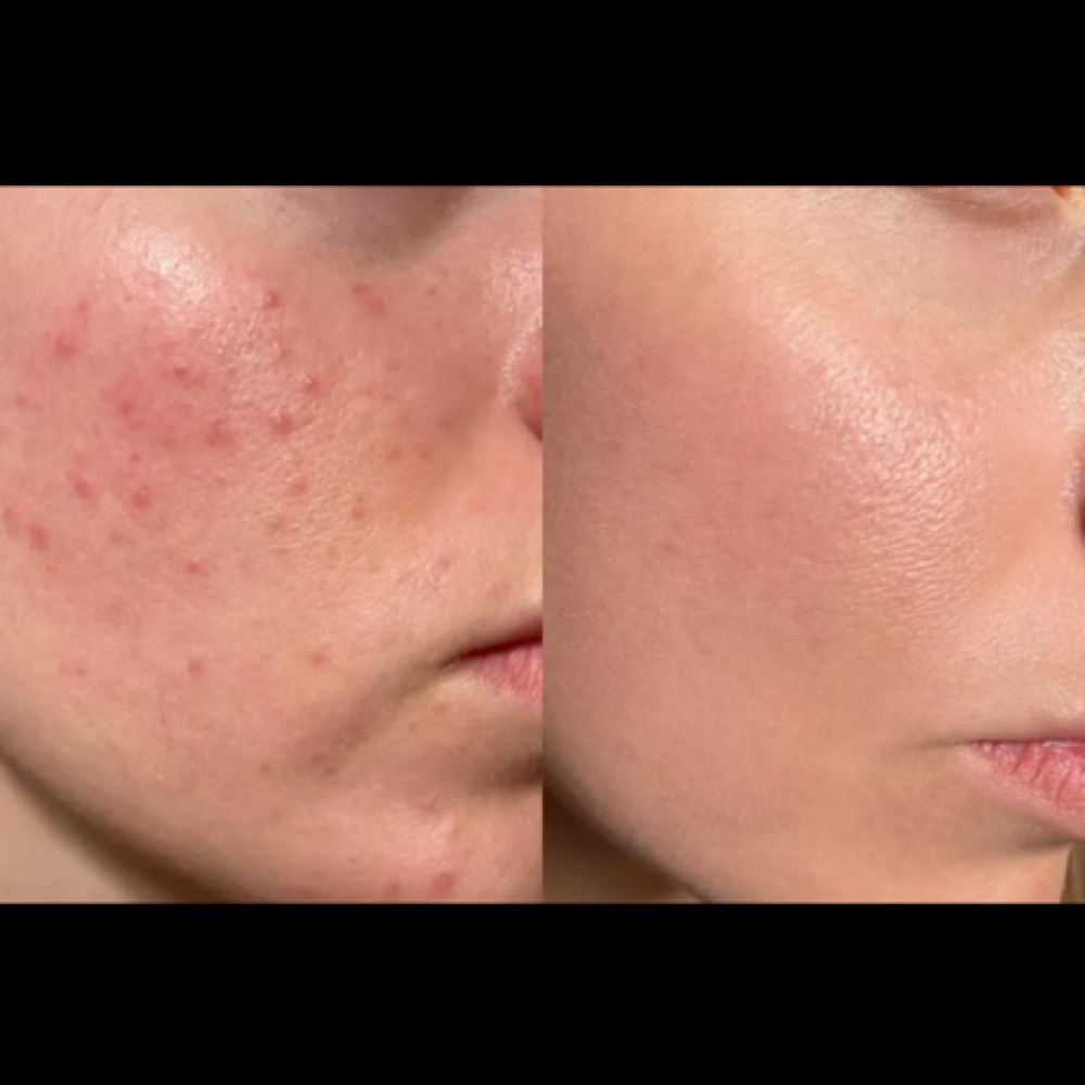 Acne/ Corrective Facial at Ashley Serene Aesthetic LLC in Clearwater, FL