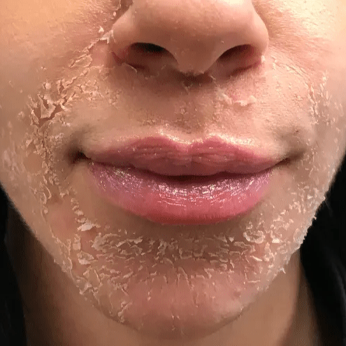 Chemical Peel at Aesthetica Organic Spa in Houston, TX