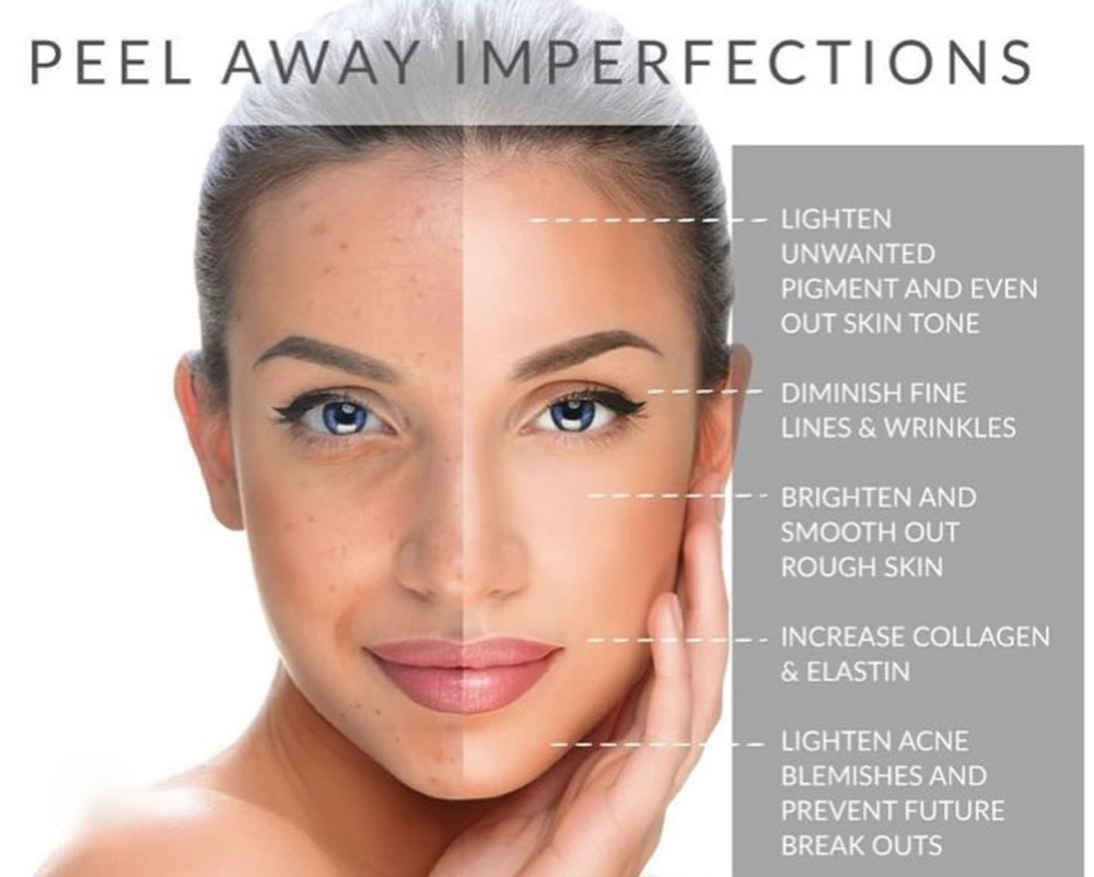 Facial Lite To medium Peel