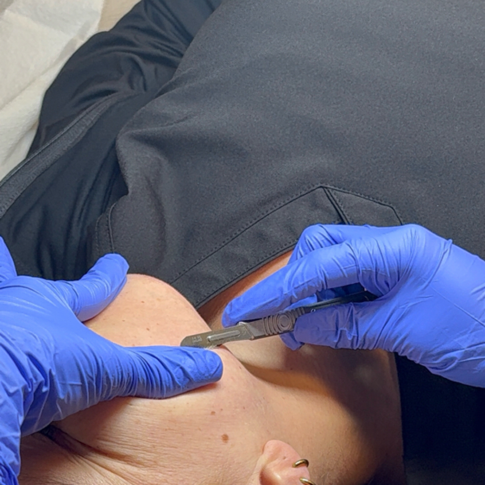 dermaplane express facial at kbabybeauty in emmaus, PA
