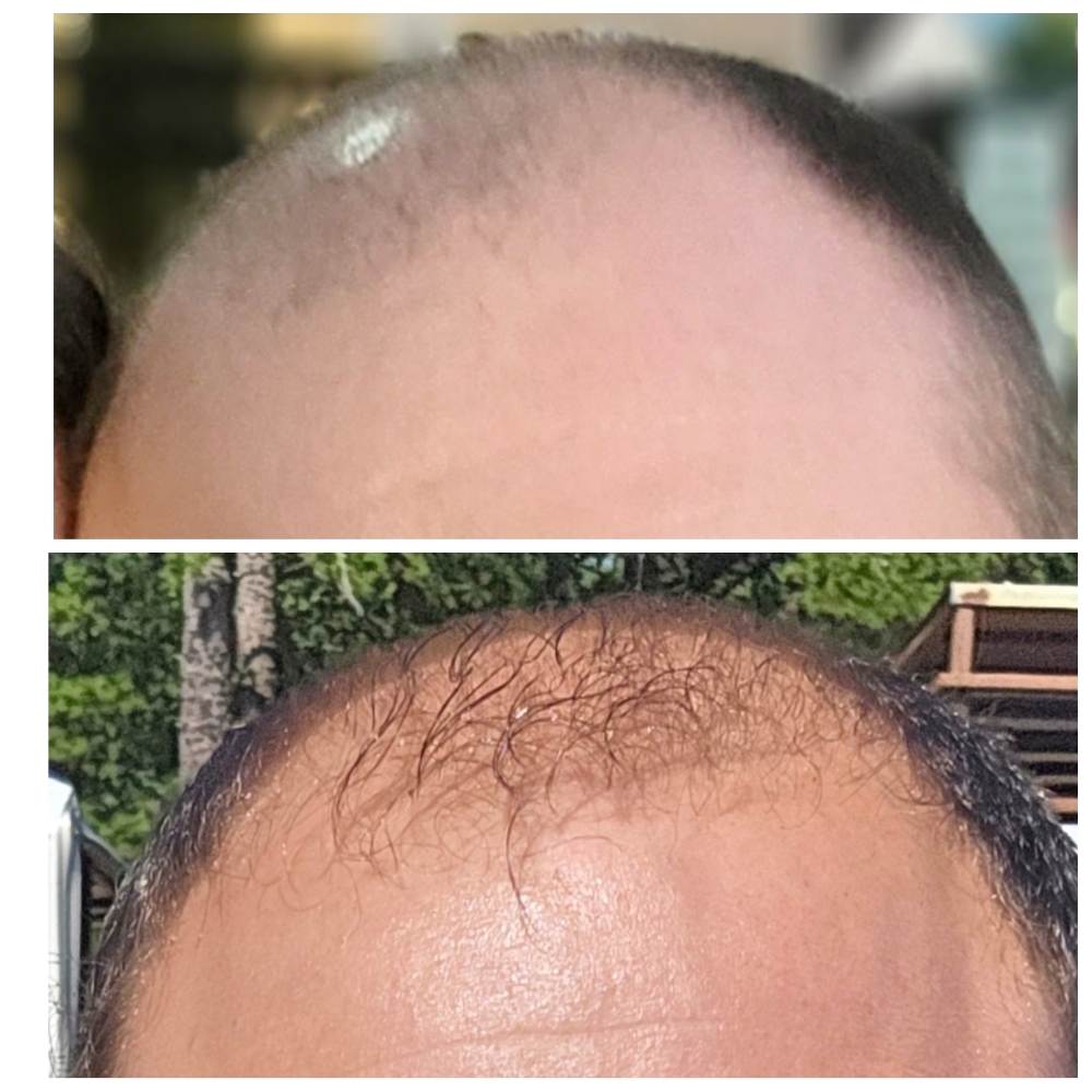 Hair Restoration at True To You Esthetics LLC Skin Care Studio in Bernville, PA