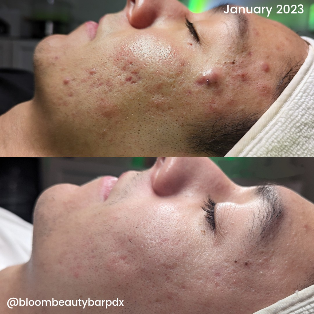 Acne Bootcamp Consult + Treatment