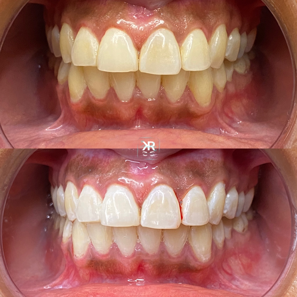 Teeth Whitening (60 Minute Session)