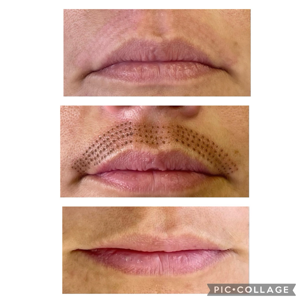 Lip Lift/Smile Line Fibroblasting