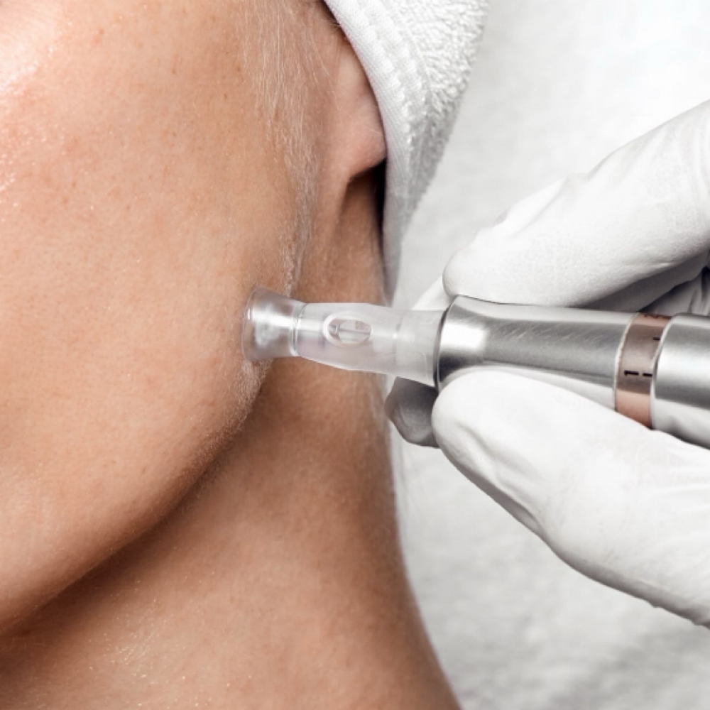 The Aura Nano-Infusion at Aura Esthetics in Wichita, KS