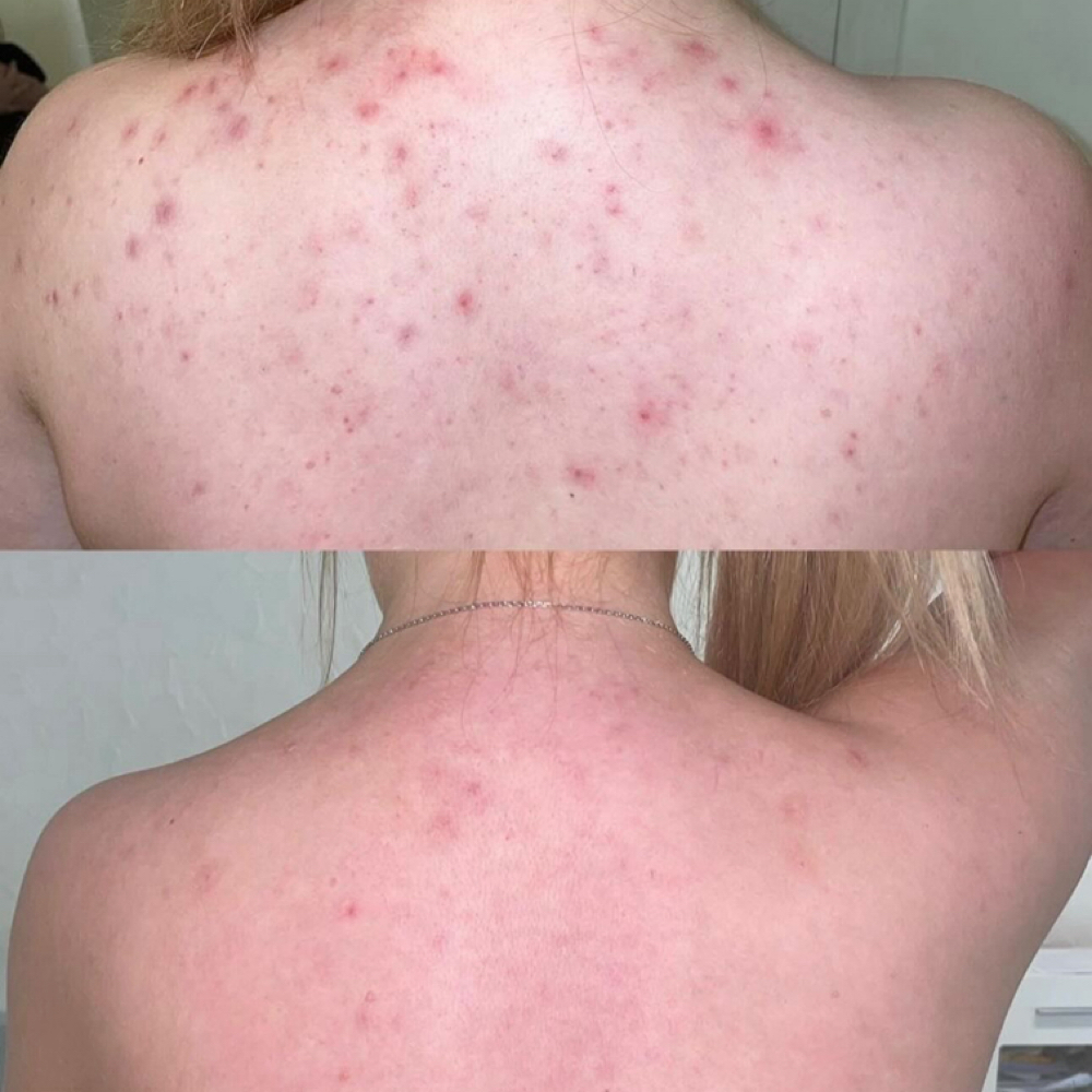 OrganoPeel Back Treatment at Batool’s Esthetics in Rocklin, CA