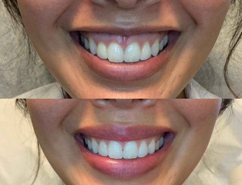 Lip Flip Botox Treatment at Glam X Sam MedBeauty in Andrews, TX