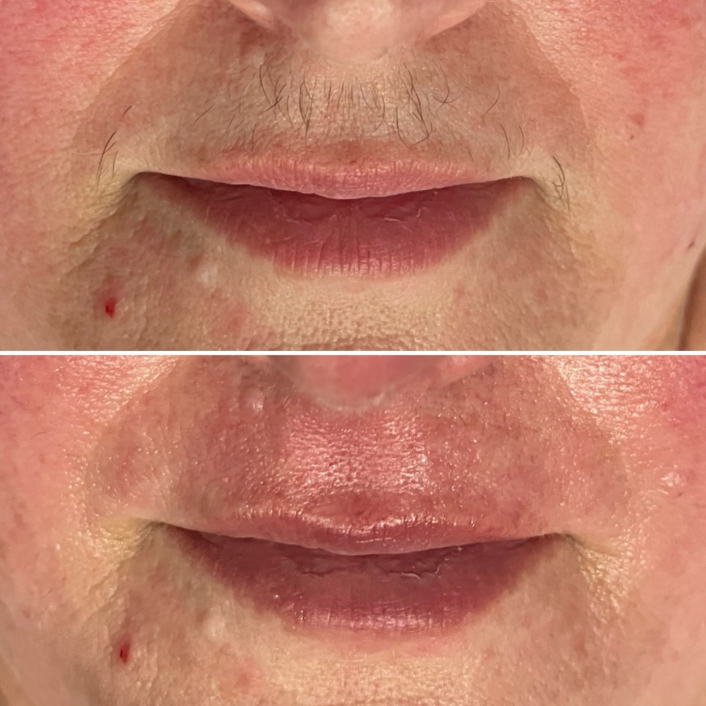 Upperlip Wax