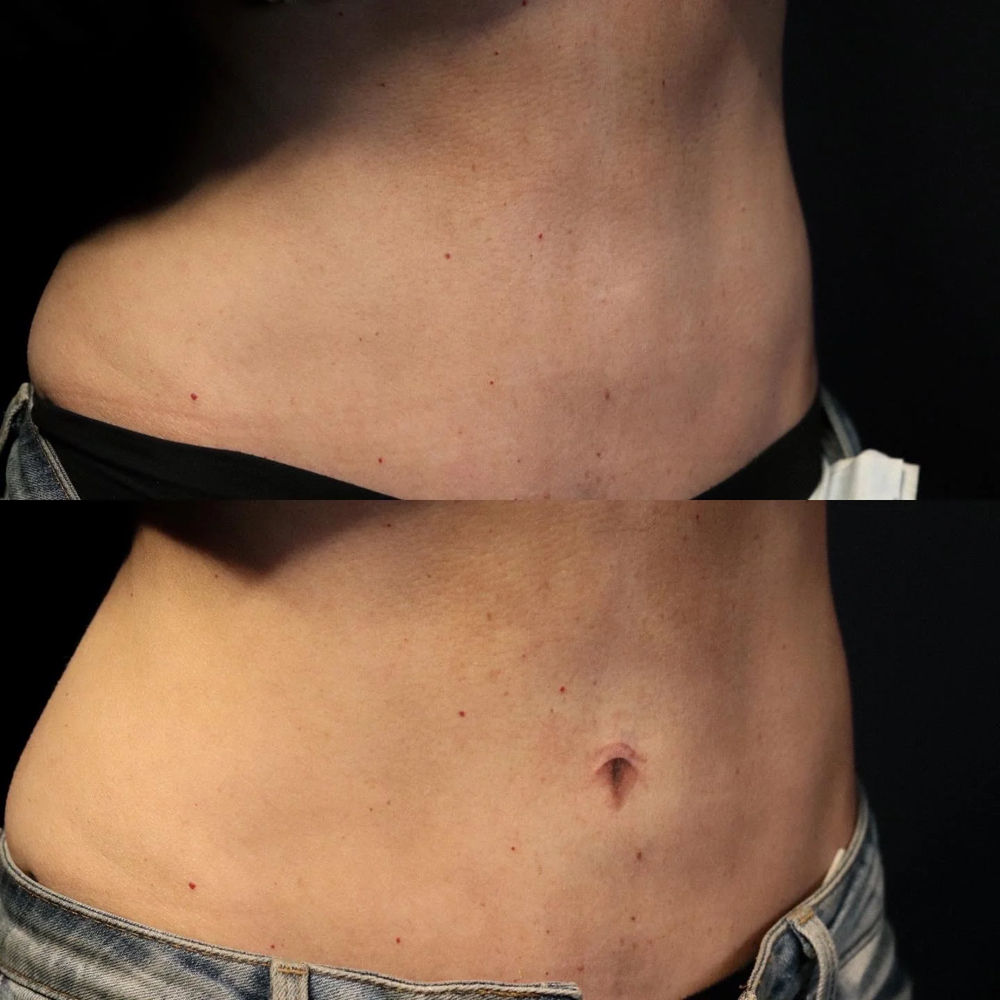 3D Belly Button Tattooing
