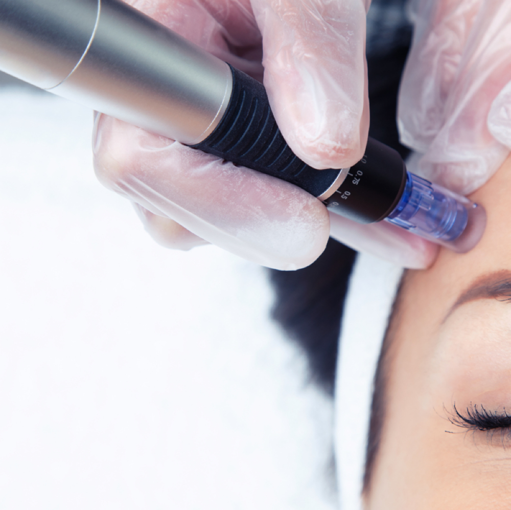Microneedling at Pate Aesthetics in Morristown, TN