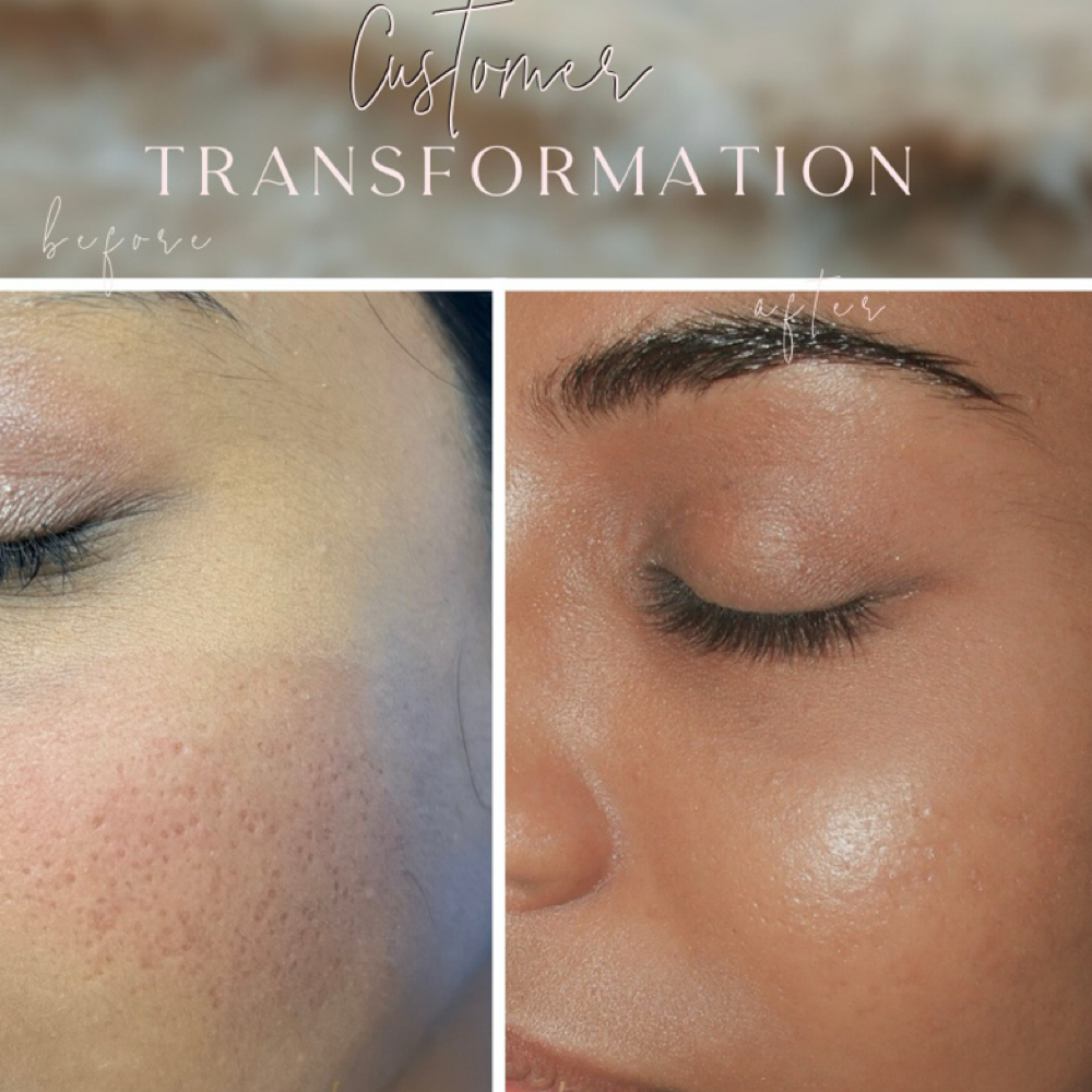 ACNE SCARS at PMU ink and beauty in Monterey, CA
