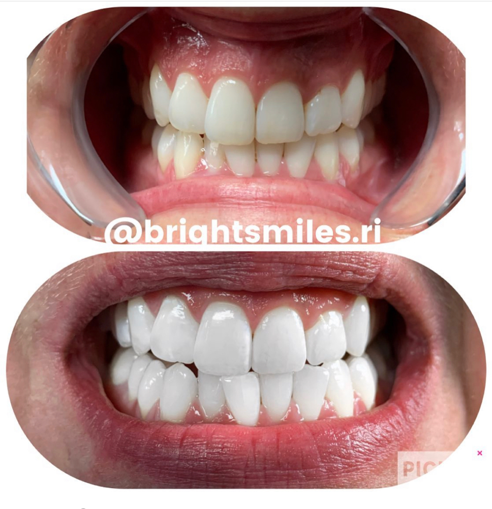 Teeth Whitening 60 Minute Session