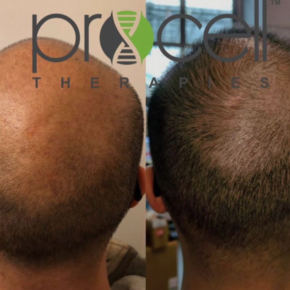 Hair Regrowth Package (3 Sessions) at It’s Your Beauty Time in Downey, CA