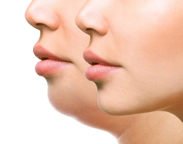 Kybella