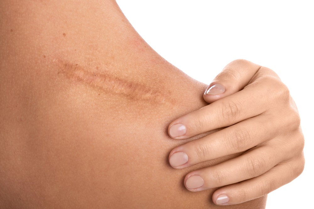 Scar Lightening