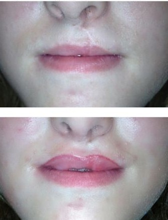 Lip Border Restoration w/camouflage