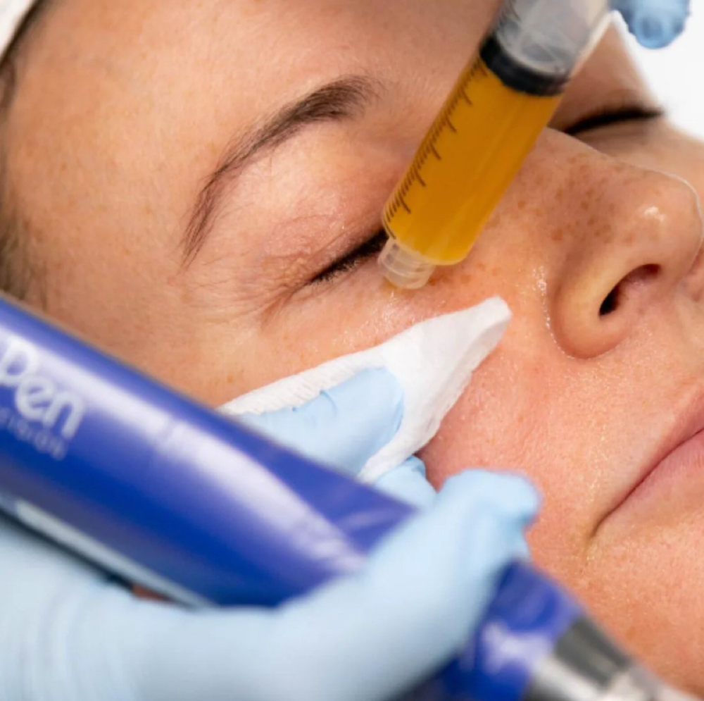 PRP Microneedling at Chatuge Med Spa & Fitness in Hiawassee, GA