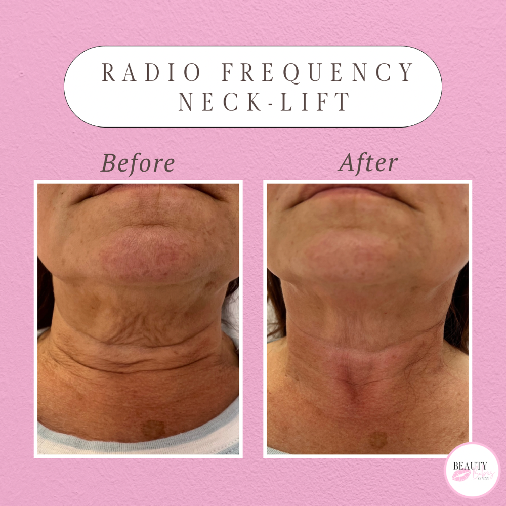 Non-Surgical Neck-Lift