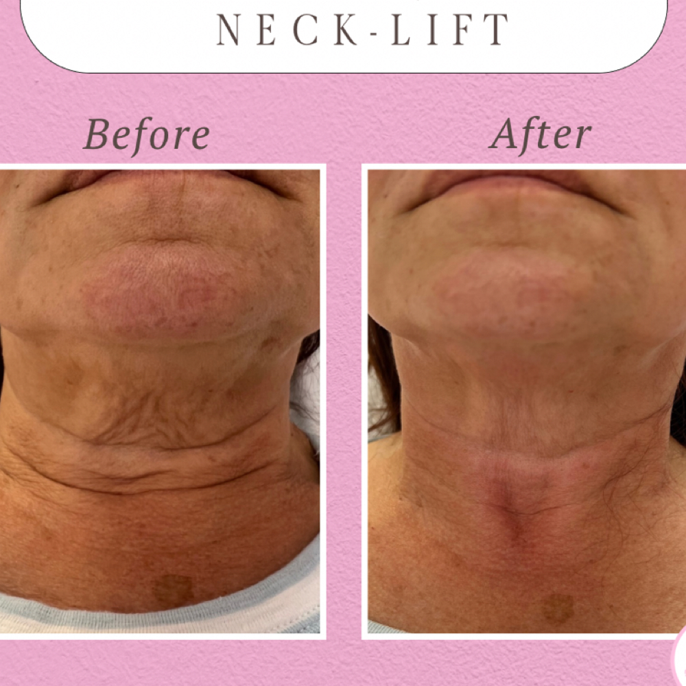 Non-Surgical Neck-Lift at Beauty Babes of WNY in Tonawanda, NY