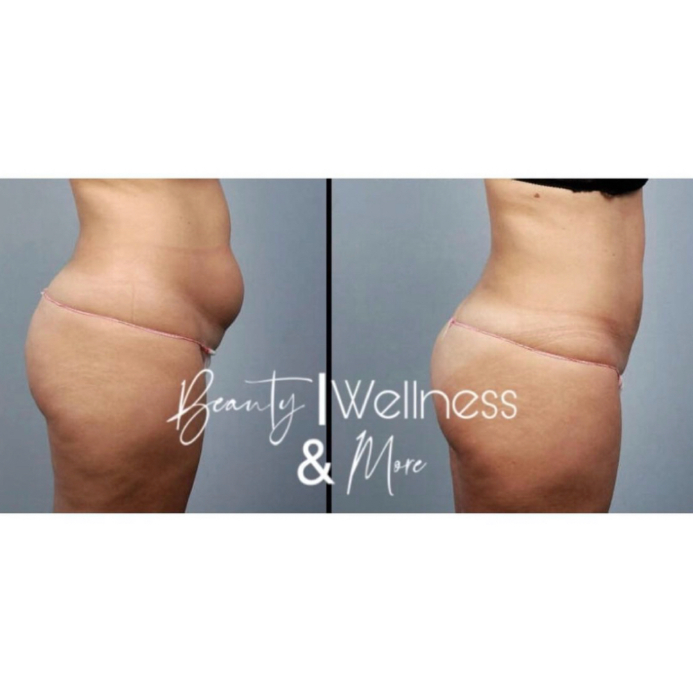 Non-Invasive Body Sculpting Session at Beauty, Wellness & More in Los Angeles, CA