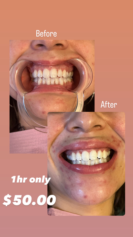 Teeth Whitening Treatment
