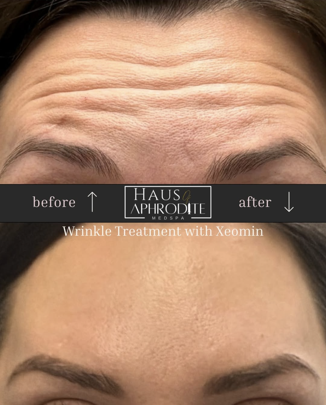 Xeomin - Forehead