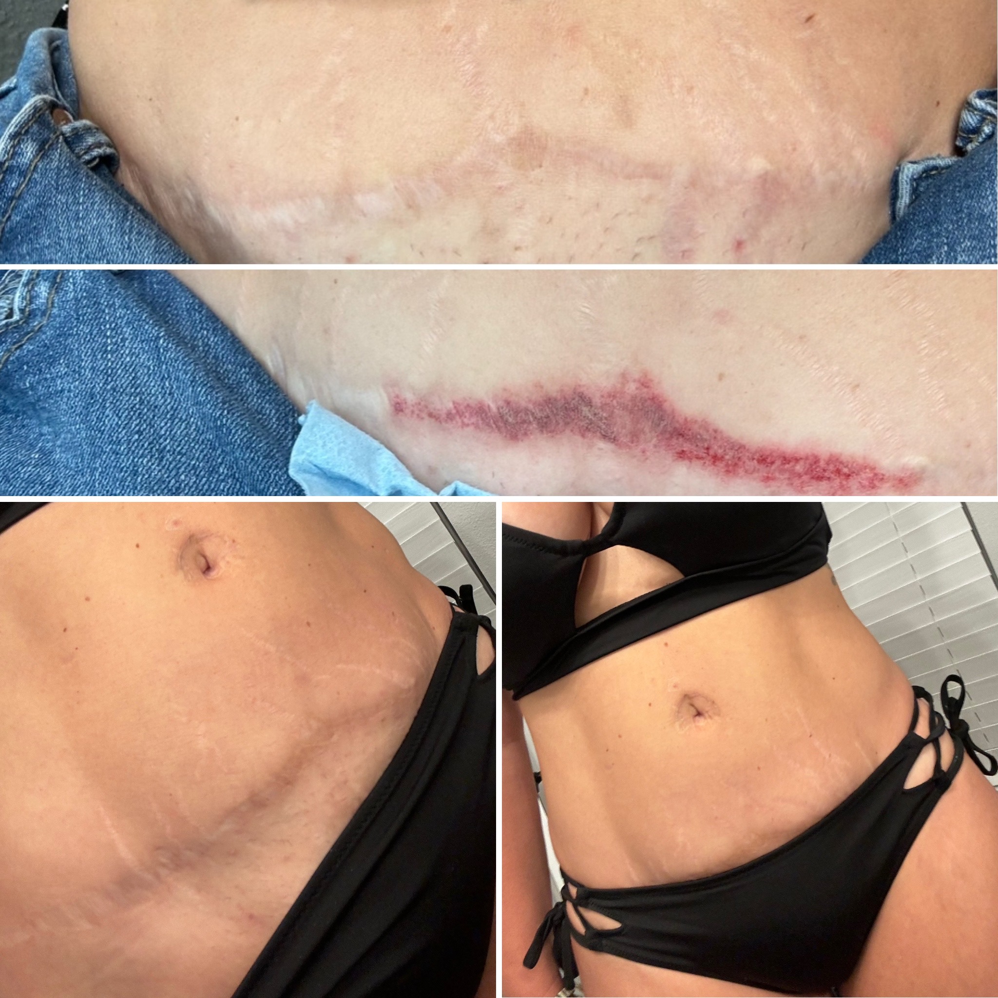 Scar & Stretch Mark Consult.