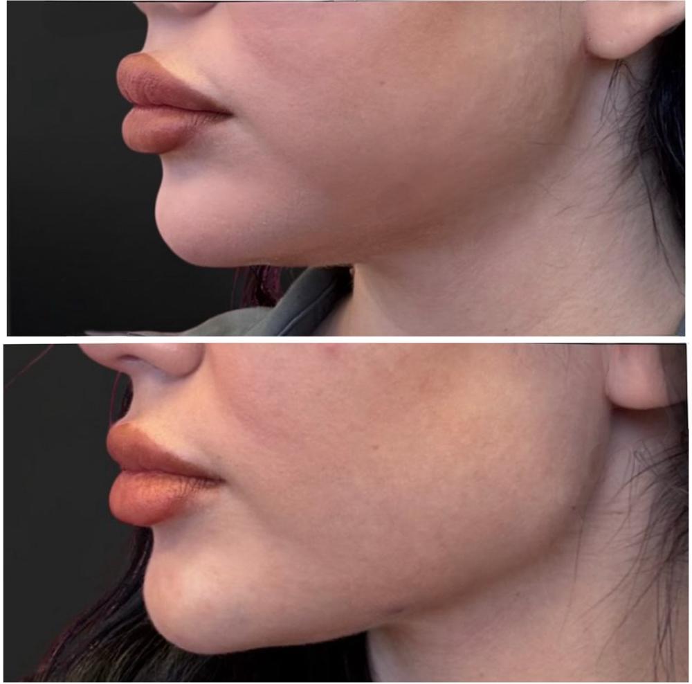 Chin filler