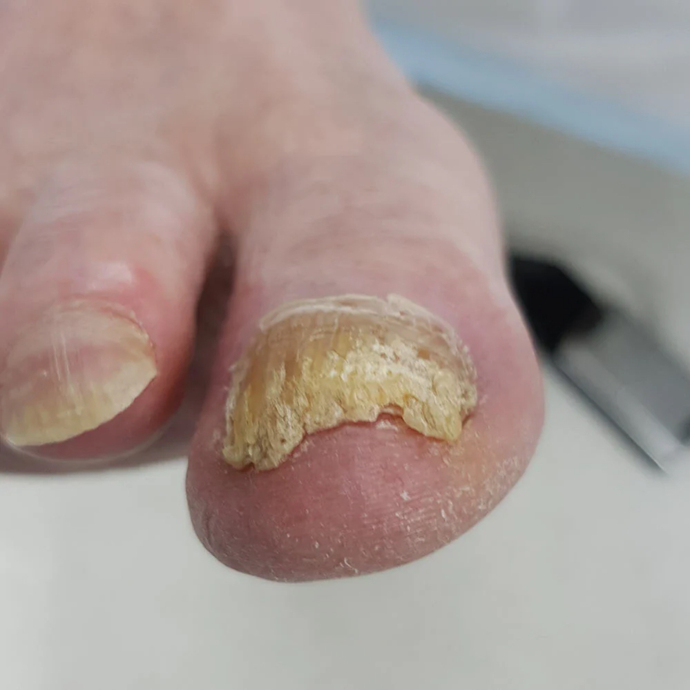 E-FILE PEDICURE (COMPLICATIONS)