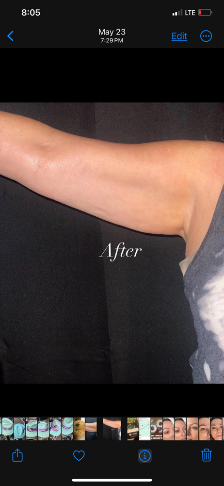 Noninvasive Body Sculpting