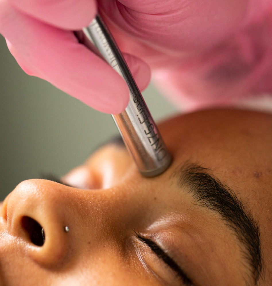 Just Microderm It !
