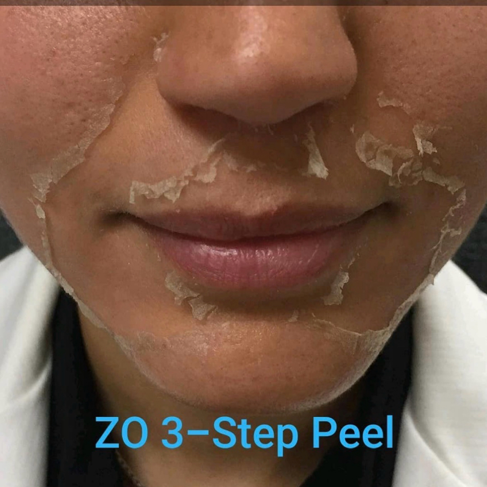 ZO® 3-Step Peel at Arosa Aesthetics in Reno, NV