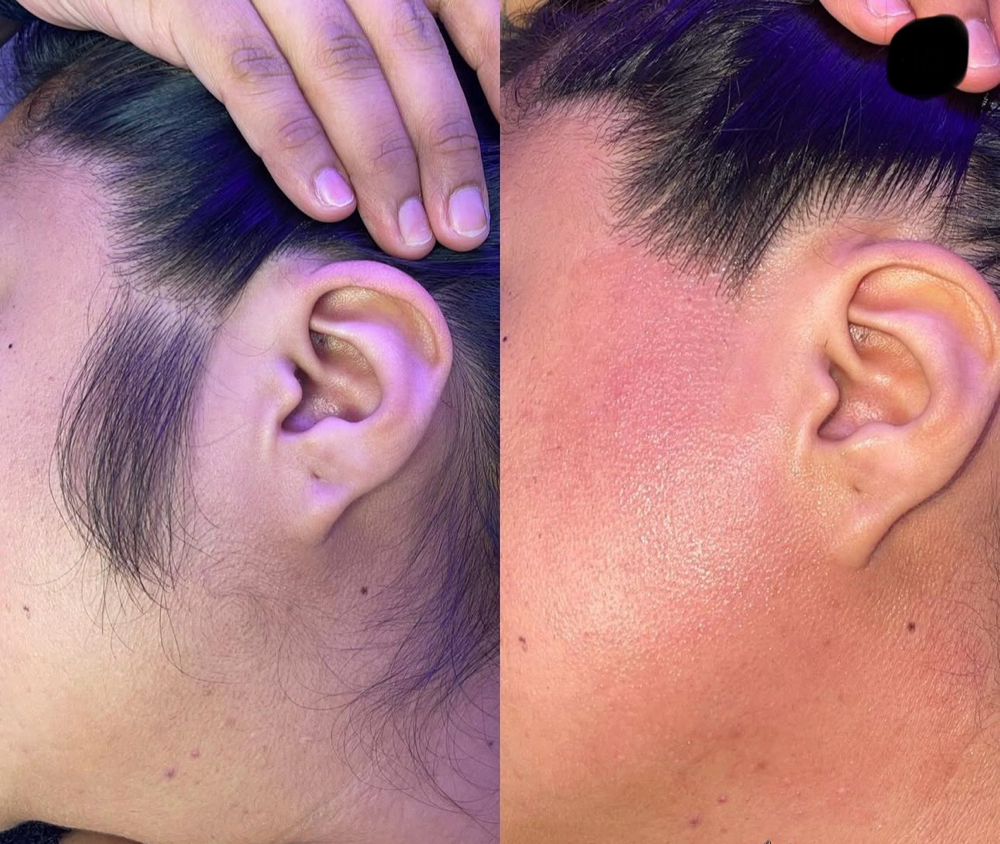 Sideburns at Chosen Esthetics in Pasadena, TX
