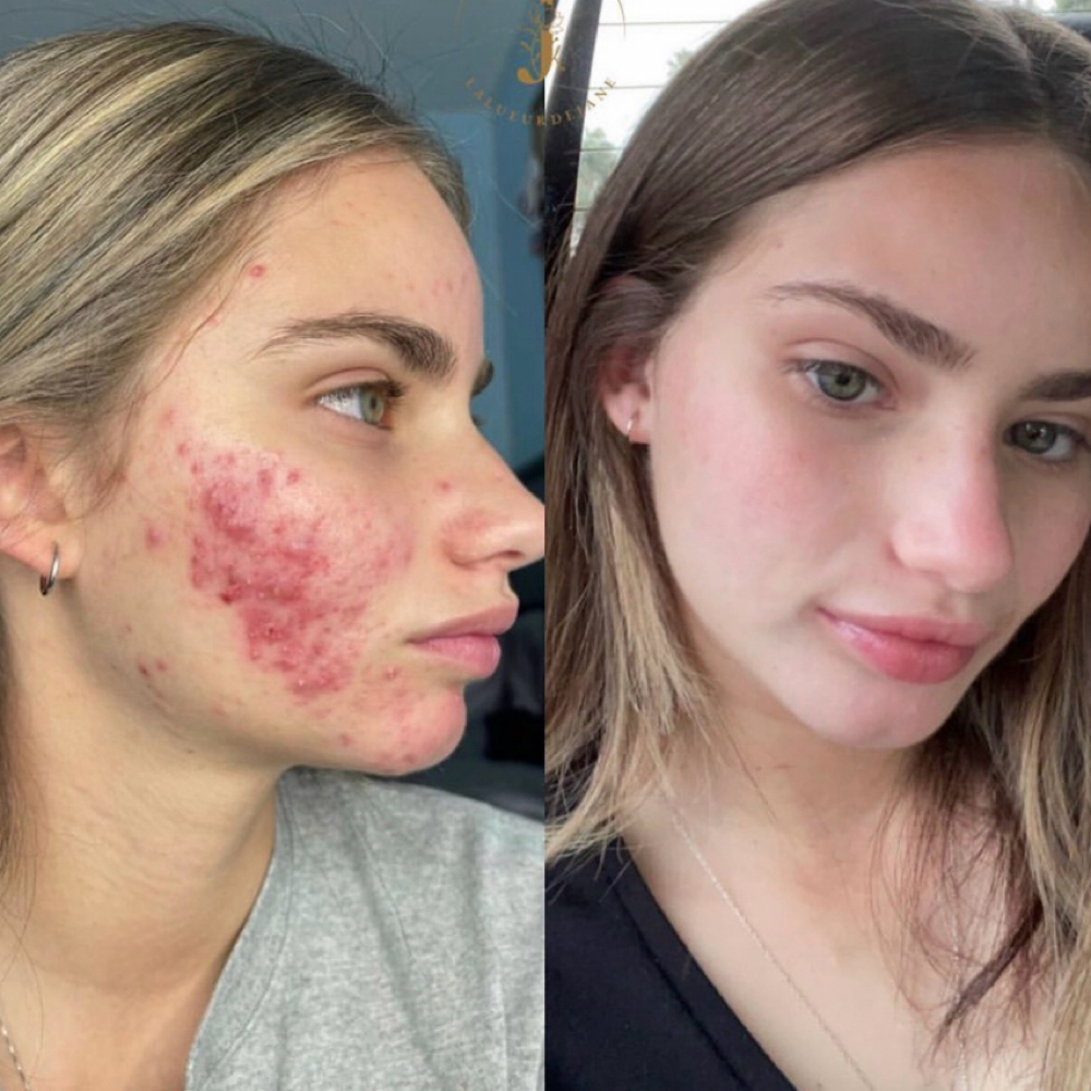 Acne Reset Facial at Lalueurdejane in Miami, FL