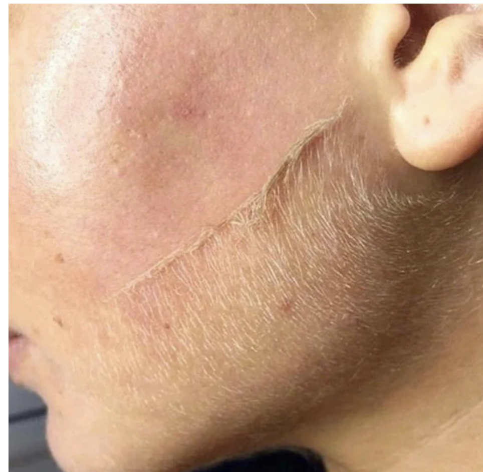 Dermaplane