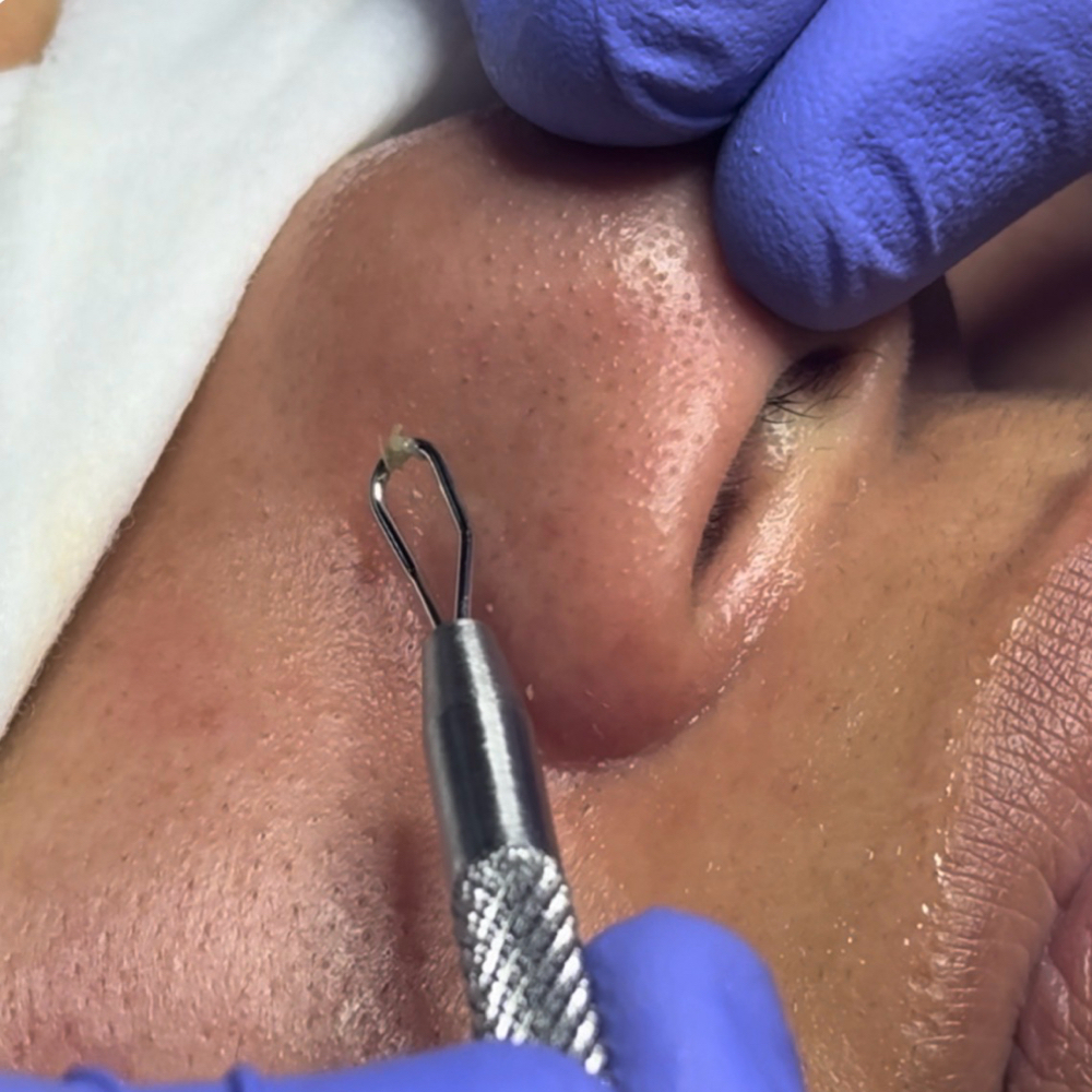 DEEP CLEANSING FACIAL at RGV PRIME AESTHETICS PLLC in Mcallen, TX