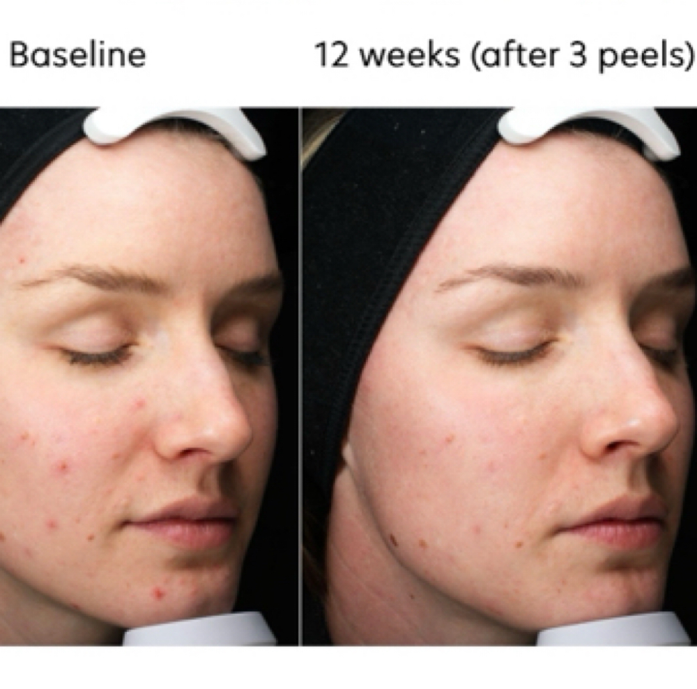 Chemical Peel - Acne/Inflammation at BE TRU BEAUTY SPA in Fairfield, CT