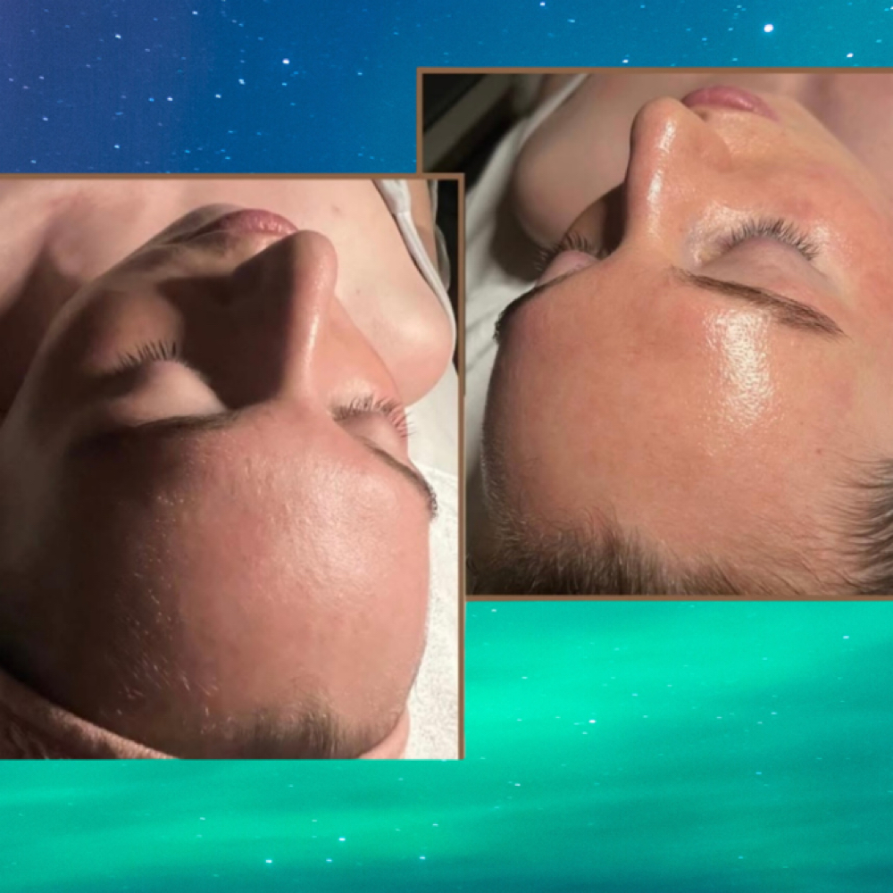 MoonGlow Microderm at MOONSTONE AESTHETICS in Fayetteville, AR