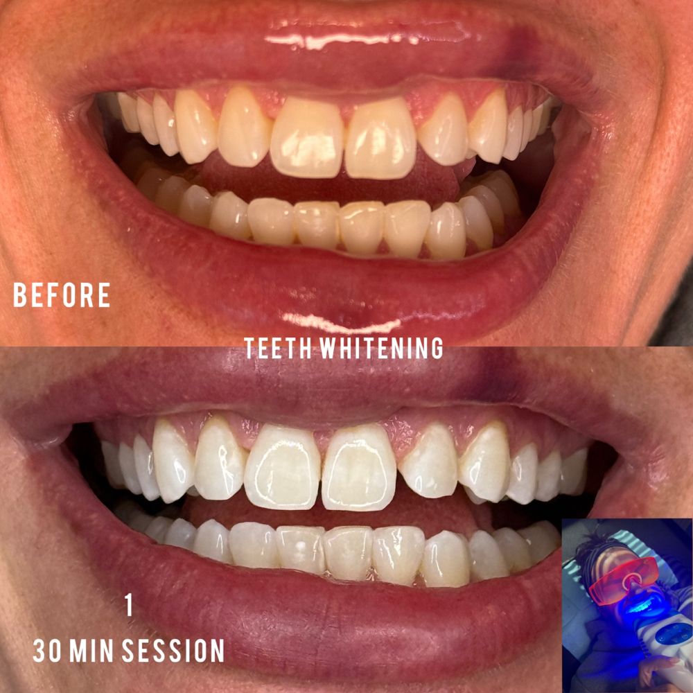 Teeth Whitening + sensitivity at Brows by Lissette in Fishers, IN