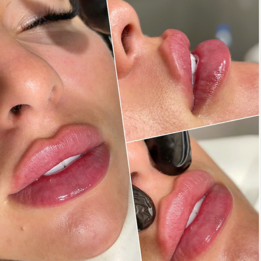 Russian Lip Filler 1/2 Syringe at Royale Medical Aesthetics and Wellness in Cheyenne, WY