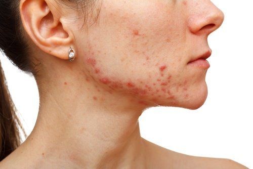 Acne Facial.