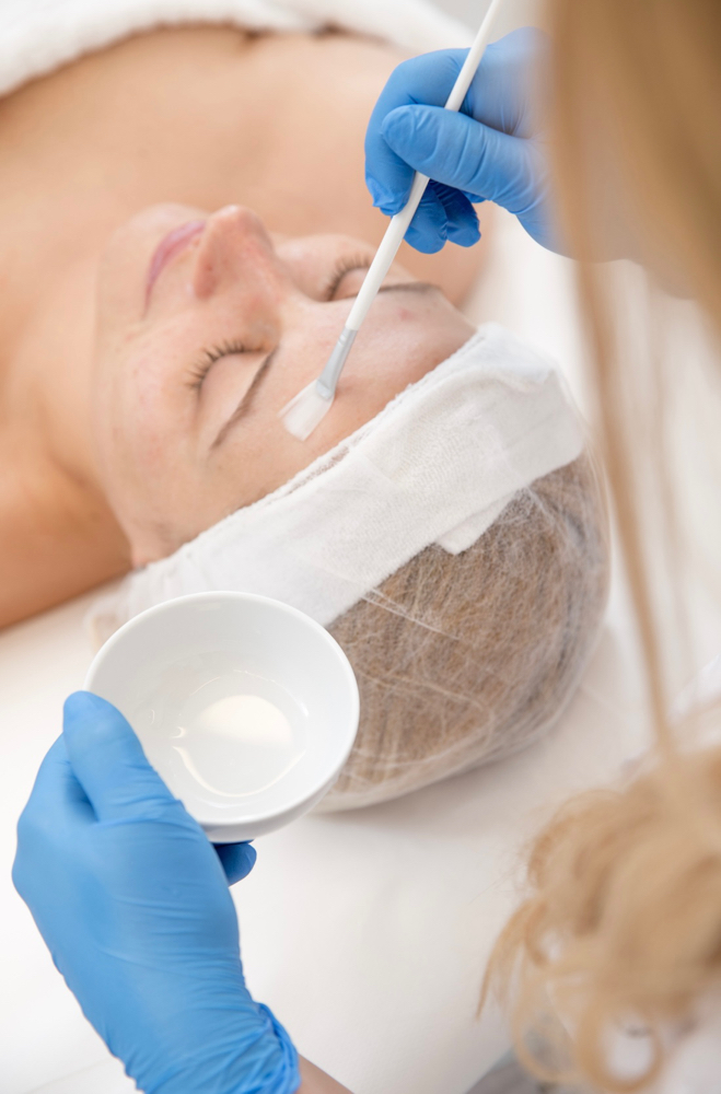 Chemical Peel