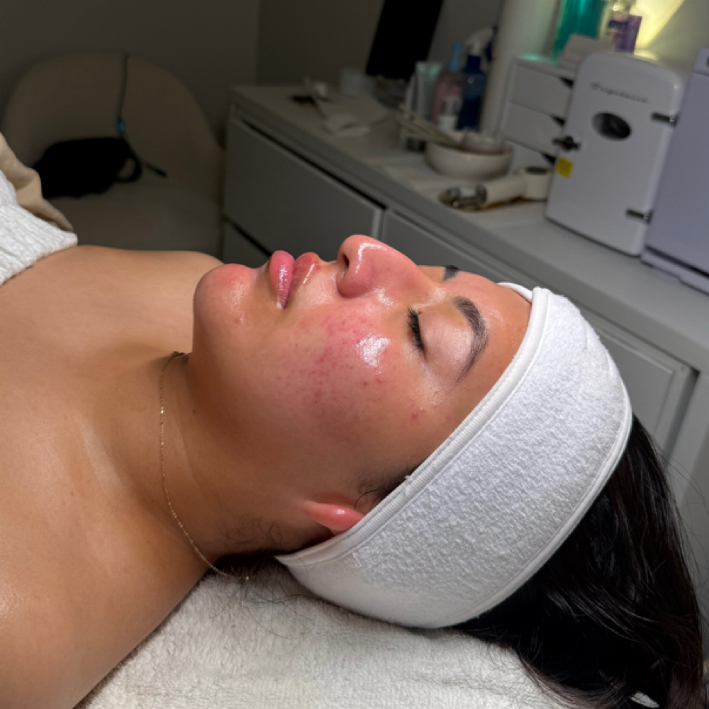 Microneedling + Dermaplane at SKNFORM in Phoenix, AZ