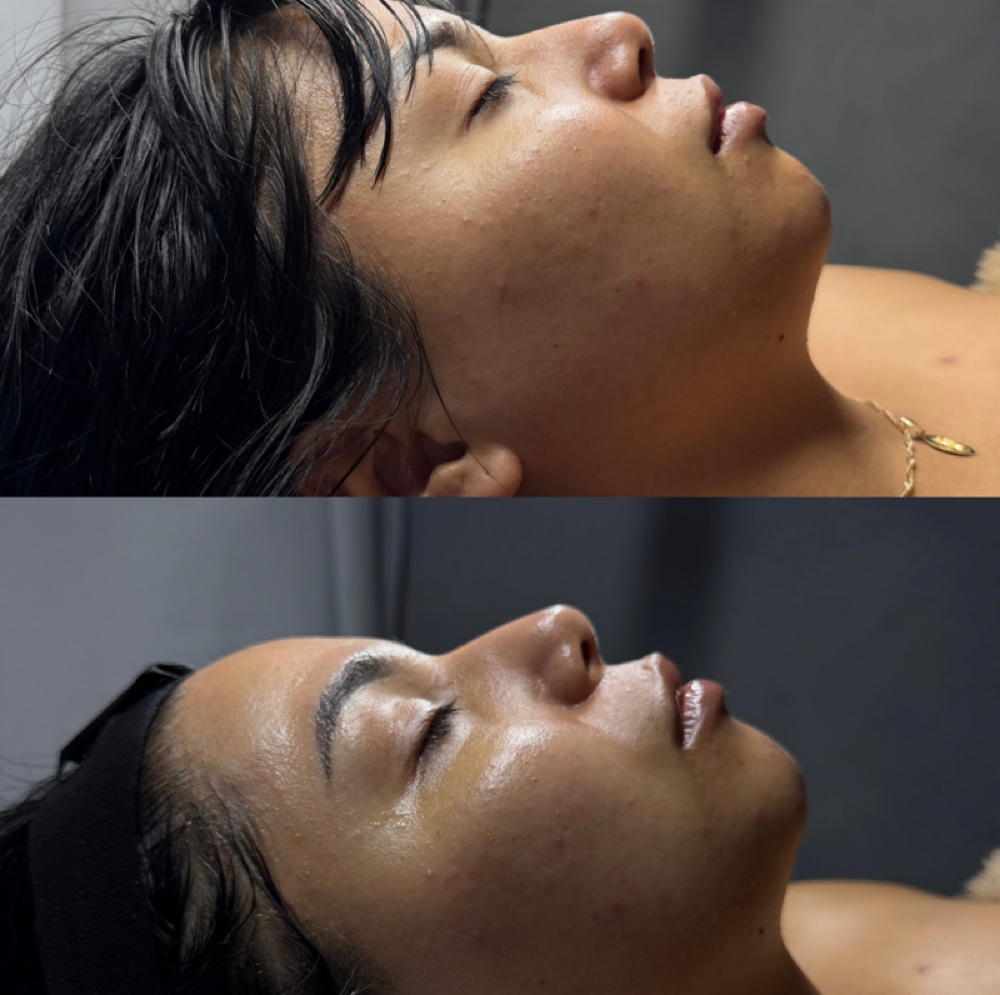 Lymphatic Facial Lift at Liminluxx in Dallas, TX