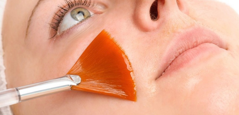 Chemical Peel